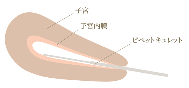 子宮内膜組織採取について