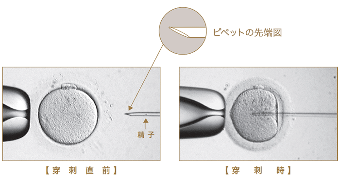 従来の顕微授精法：ICSI