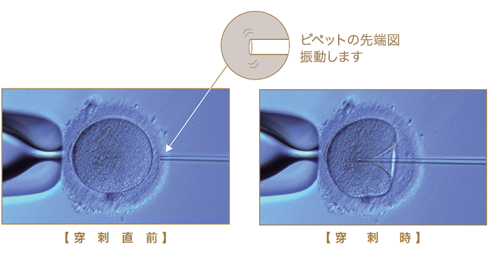 新しい顕微授精法：Piezo-ICSI