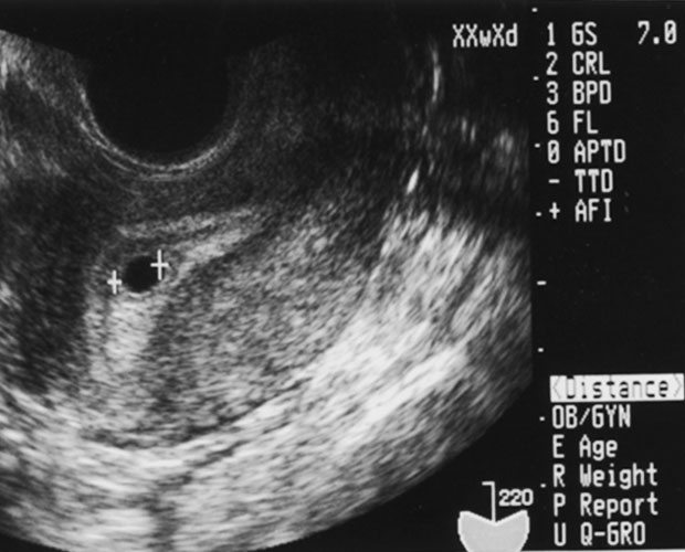 妊娠5週胎嚢 7.0㎜